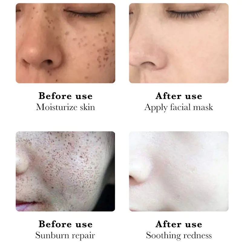 Niacinamide Whitening Spot Mask for Dark Spots and Hydration Velura
